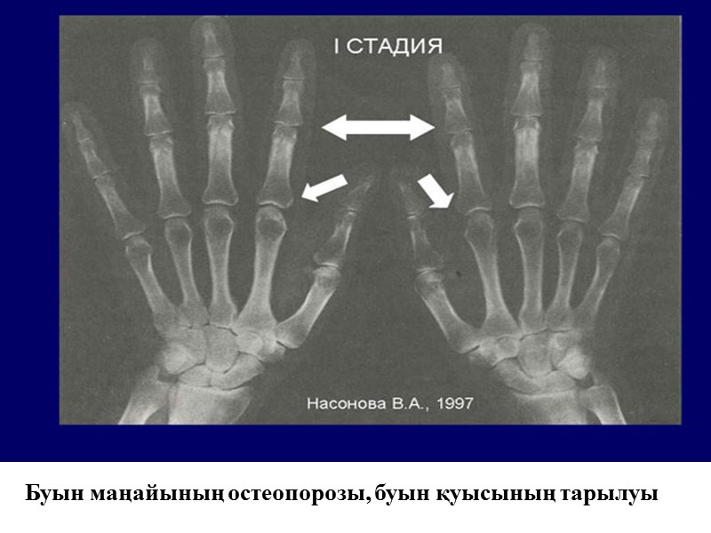 Буын маңайының остеопорозы, буын қуысының тарылуы